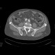 Aneurysm of the abdominal aorta, AAA, aorto-iliac stentgraft: CT - Computed tomography